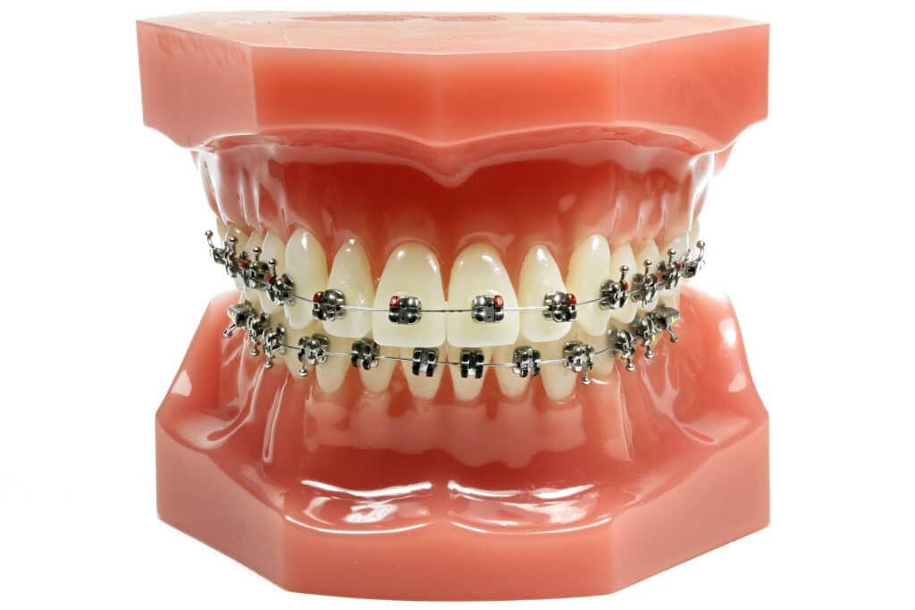 Traditional Braces Alamogordo
