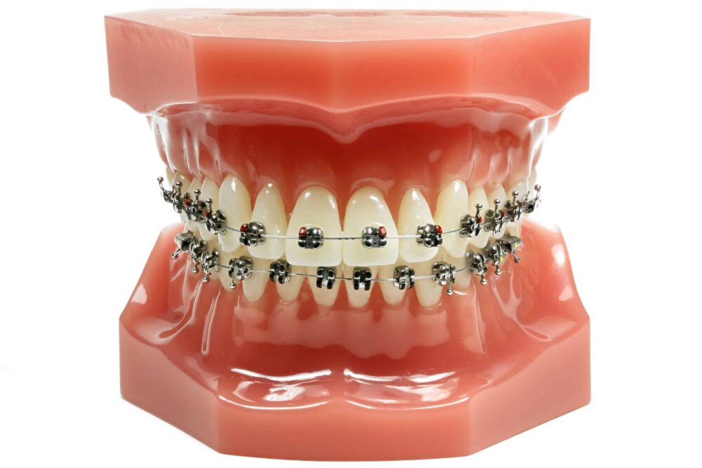 Traditional Braces Alamogordo